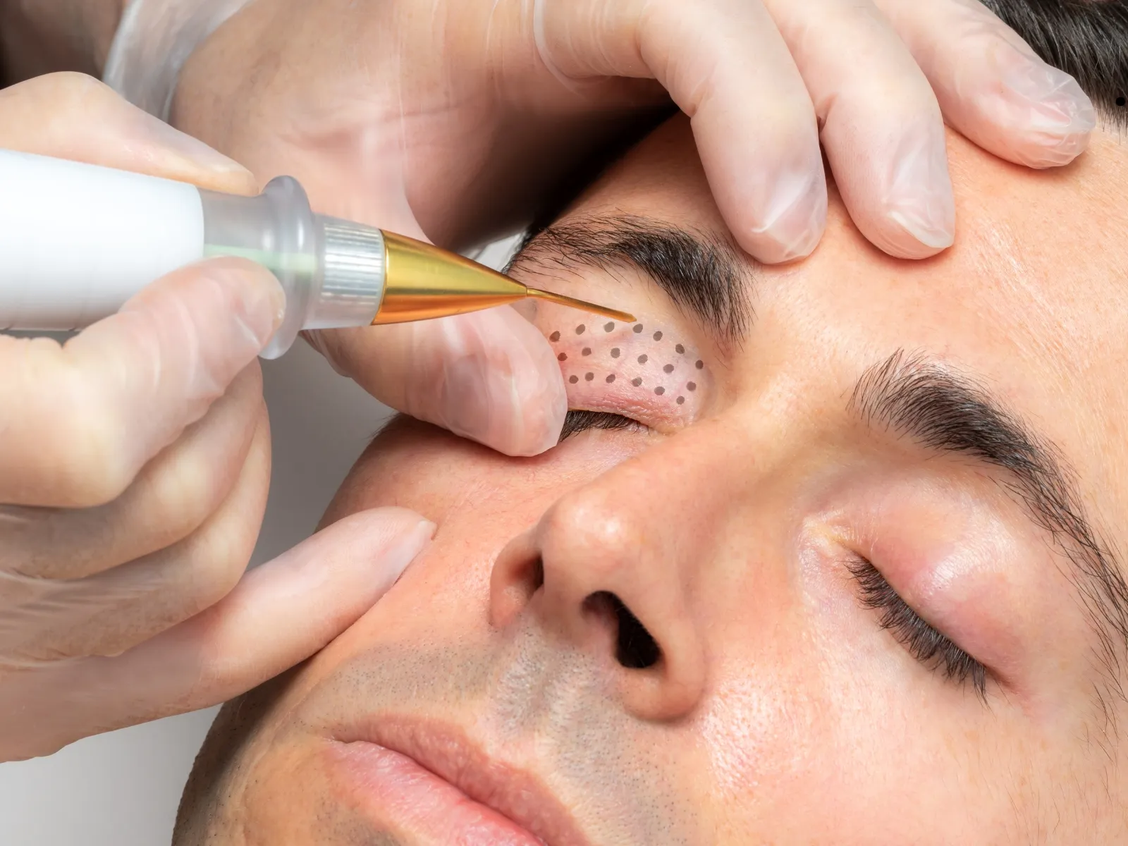 jett-plasma-eyelid-rejuvenation-and-lesion-removal